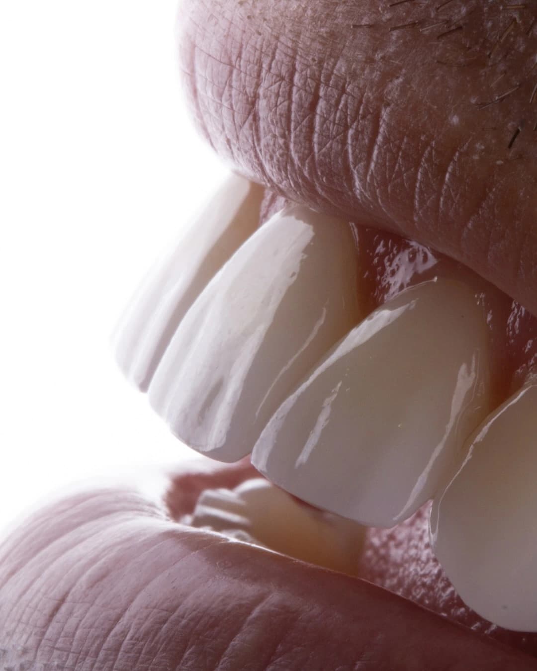 Detalhe lateral de sorriso publicado pelo Dr. Rodolfo Segawa em 11 de novembro de 2025.