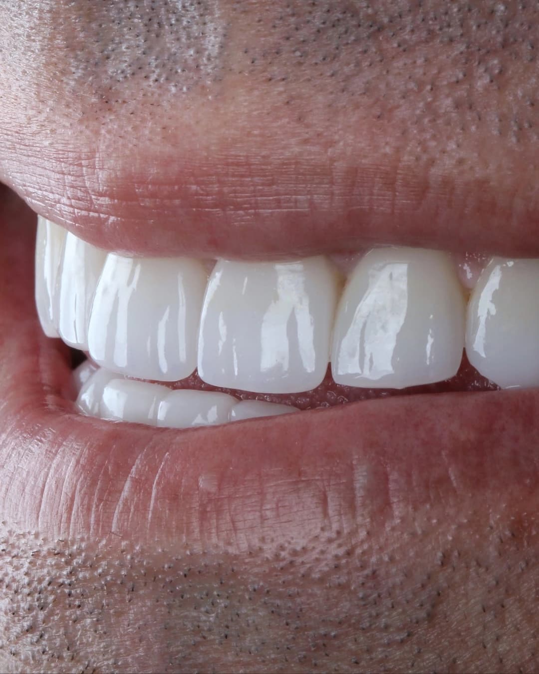 Detalhe frontal do sorriso em publicação do Dr. Rodolfo sobre lentes de porcelana.