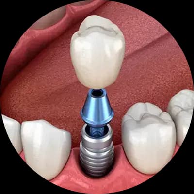 Illustration of a single dental implant, with the implant, the abutment and the crown.