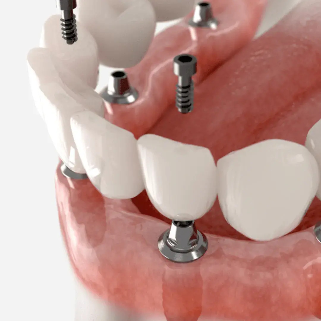 Illustration of a fixed full-arch prosthesis supported by dental implants.